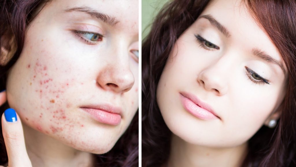 Acne Treatment in Lahore