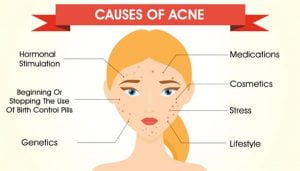 What are the Causes of Acne