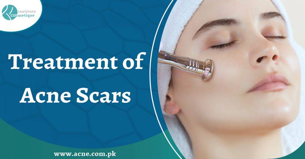 Acne Scars Treatment