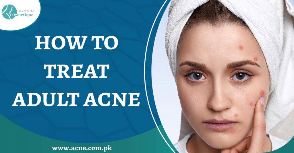 Adult acne treatment