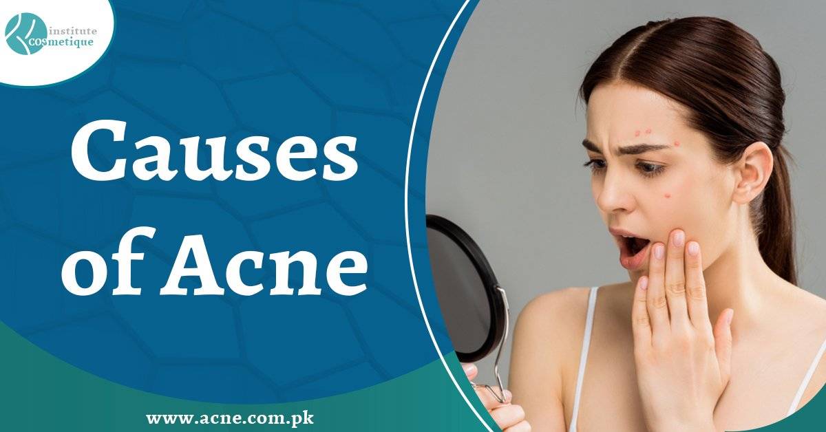 causes-of-acne-treatment, best acne treatment in Lahore