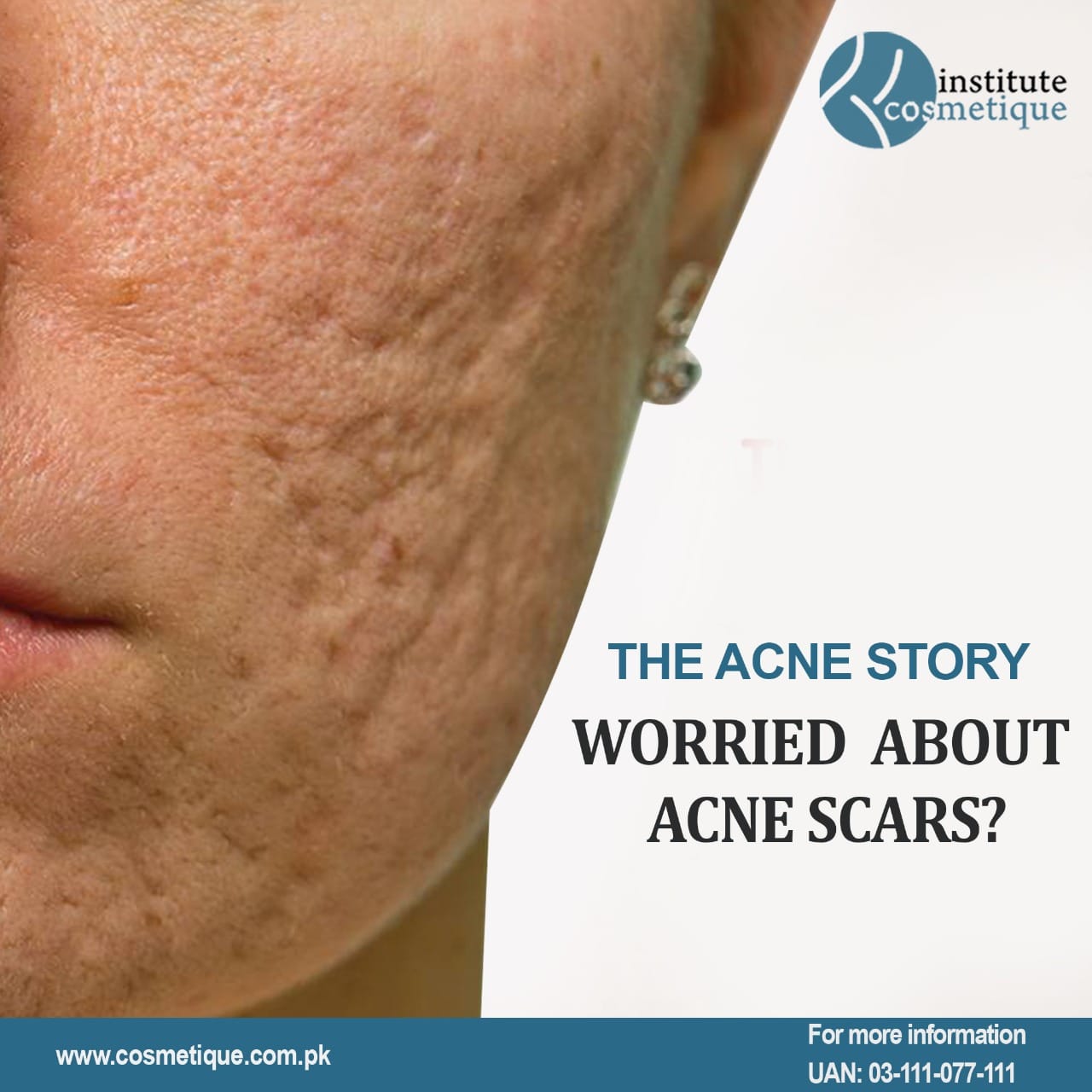 Best Acne Treatment in Lahore