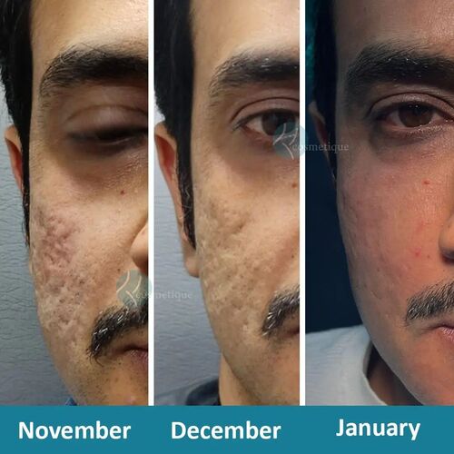 Befor and After Acne Treatment, laser treatment for acne scars price in Pakistan
